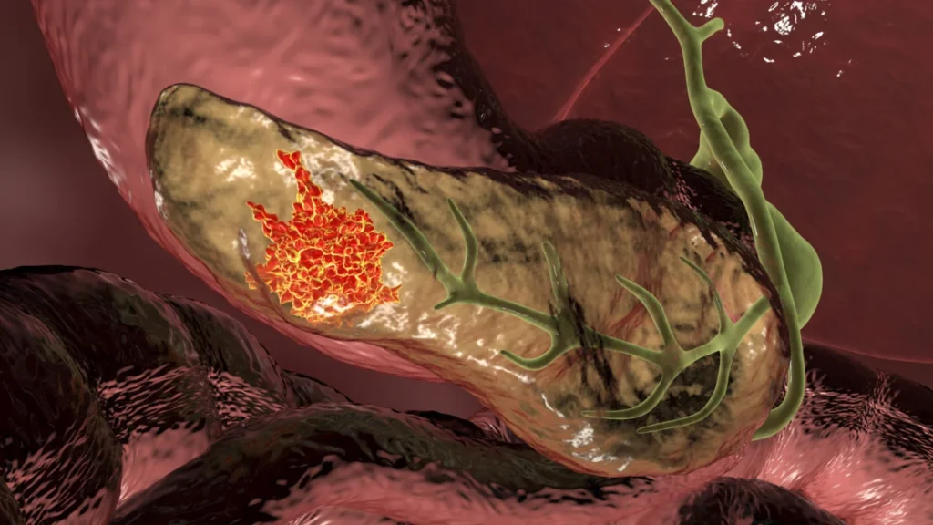 breakthrough-in-oncology-experimental-vaccine-shows-promise-in-intercepting-pancreatic-cancer