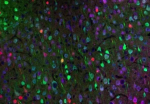 rewiring-the-diseased-brain-new-breakthrough-in-huntingtons-disease-research