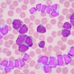 unlocking-the-epigenomic-code-a-new-frontier-in-acute-myeloid-leukemia-treatment