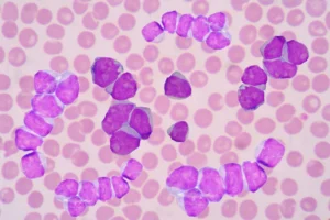 unlocking-the-epigenomic-code-a-new-frontier-in-acute-myeloid-leukemia-treatment