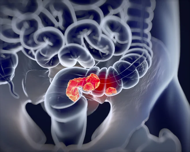ai-driven-breakthrough-new-roadmap-emerges-for-treating-hard-to-beat-colorectal-cancer